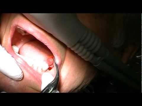 Physics Forceps Tooth Extraction Lower Molar #18