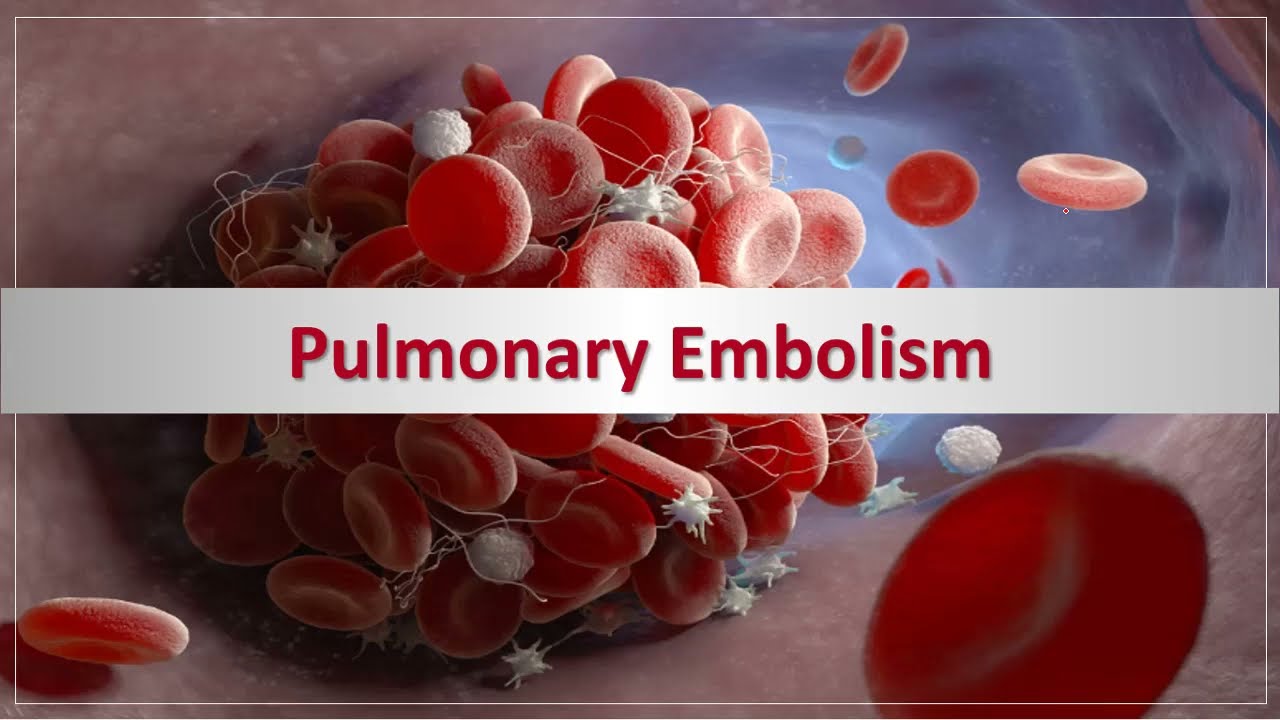 Pulmonary Embolism | الانصمام الرئوي
