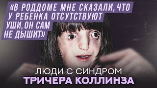 картинка: Люди с синдромом Тричера Коллинза | Хочу спросить