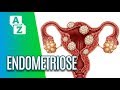 Sintomas e tratamentos da endometriose - De A a Zuca (11/06/19)