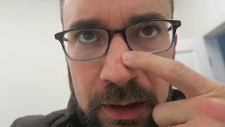 BEAUTY TIP: Removing An Explosion From Your Face BEAUTY TIP: Removing An Explosion From Your Face