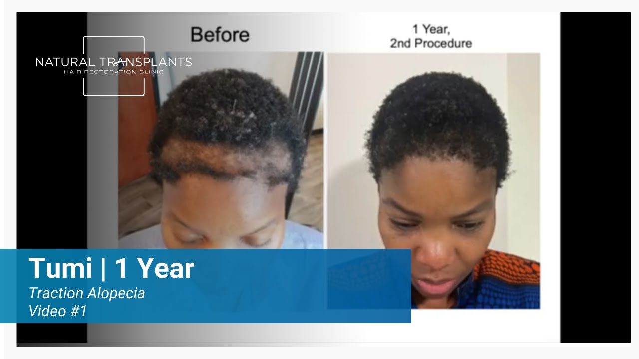 Hair Restoration Journey: Overcoming Traction Alopecia with Natural Transplants | Dr. Huebner (Tumi)