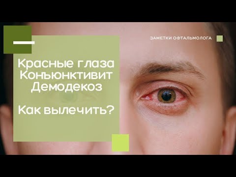 Красные глаза || Конъюнктивит || Демодекоз