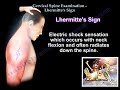 Cervical Spine Examination, Lhermitte's Sign - Everything You Need To Know - Dr. Nabil Ebraheim