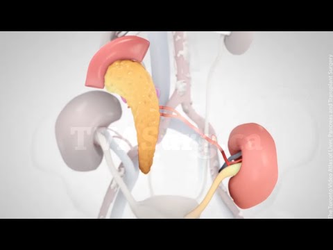 Synchronous pancreas-kidney (SPK) transplant