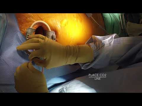 Minimally Invasive Aortic Valve Replacement by Thoracotomy: Step-by-Step Guide