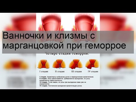 Ванночки и клизмы с марганцовкой при геморрое