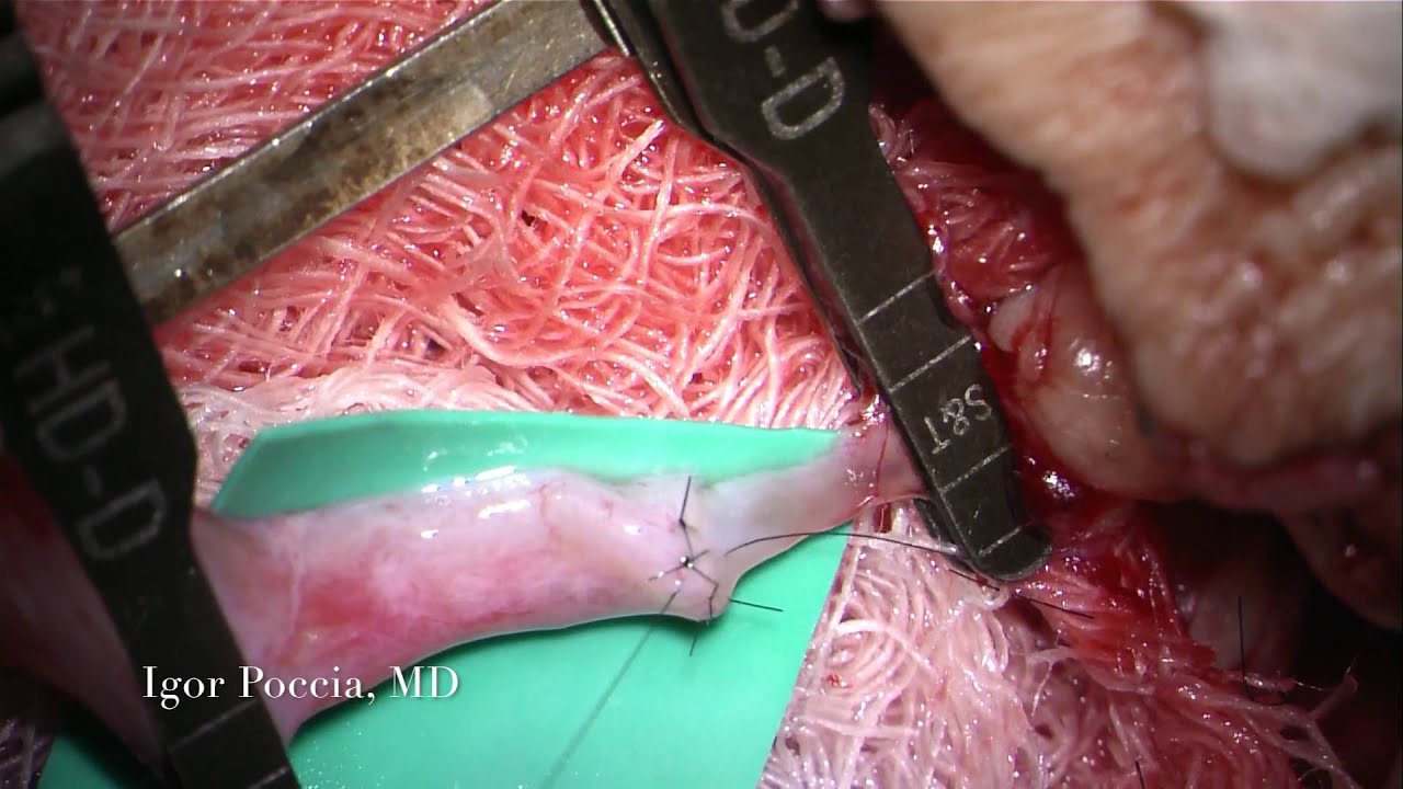 vascular anastomosis