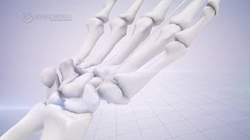 Double Medical Headless Compression Screw II