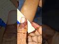 IV cannula technique video part 63 s#doctor #cannulatechnique #hospital