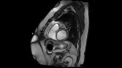 MedVoxel Cardiac MRI Left Ventricle Contour / Segmentation Demo