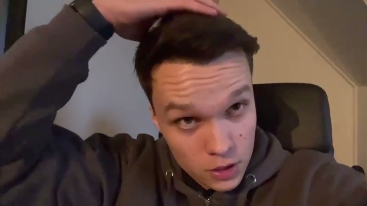 Luke's haartransplantatie: 9 maanden later en nu al superblij!