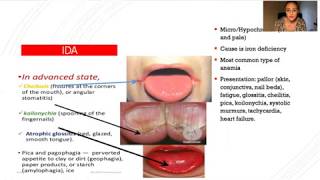 Anemia for NP boards