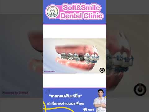 จัดฟันแก้ยื่น  รูปหน้าเปลี่ยน  #หมอชิ #softandsmiledentalclinic