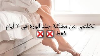 ٣ أيام فقط و تتخلصي تماما من جلد الوزة / تجهيزات عروسه العيد