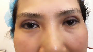 Cận Cảnh Nếp Mí Mới Cắt Mí Xong Tại Dr.Hải Lê.