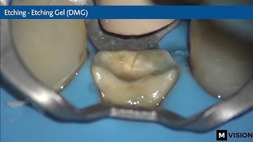 Post-endodontic treatment with the LuxaCore Z family from DMG