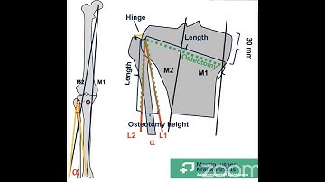 High Tibial Osteotomy for Medial Compartment OA Knee