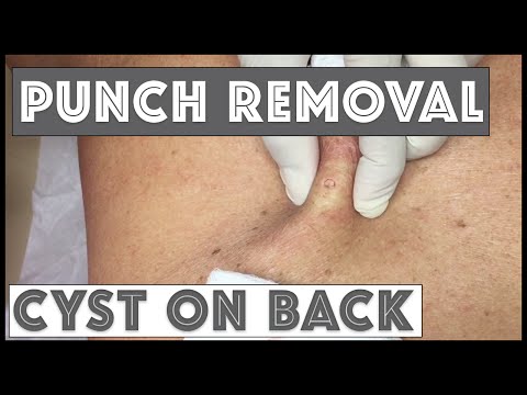 Punch Removal Of A Cyst On Back