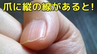 体が訴えているsosのサイン つい見逃しがちな体の救助信号とは 爪に縦の線があると Youtube