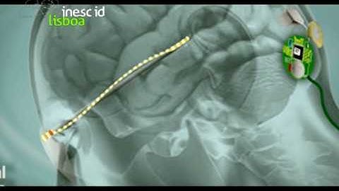 Cortivis - Cortical Visual Neuroprosthesis for the blind