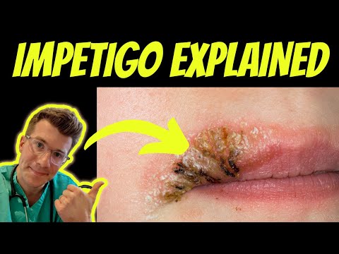 Video: Cum se vindecă Impetigo (cu imagini)