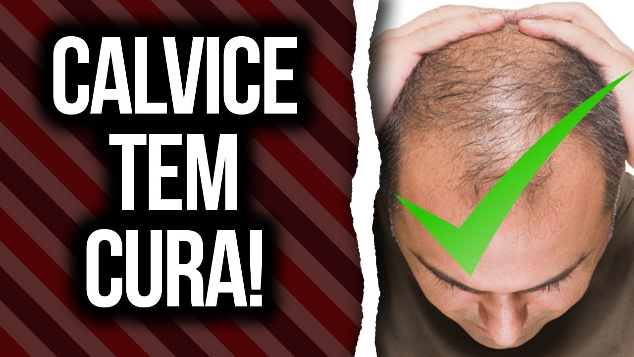 A CALVICE TEM CURA SIM! ENTENDA COMO FUNCIONA JUNTO DE UM PROFISSIONAL A CALVICE TEM CURA SIM! ENTENDA COMO FUNCIONA JUNTO DE UM PROFISSIONAL