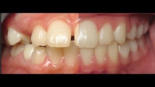 Healthy Start  - Before and After