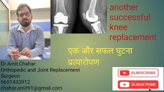 another successful knee replacement एक और सफल घुटना प्रत्यारोपण #kneeosteoarthritis #kneesurgeon