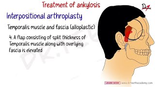 Treatment of Ankylosis- Interpositional Arthroplasty