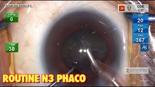 Routine N3 Phaco