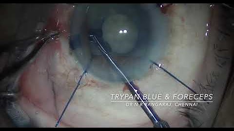 Trypan Blue, Iris Hooks, decompress mature cataract with capsulotomy