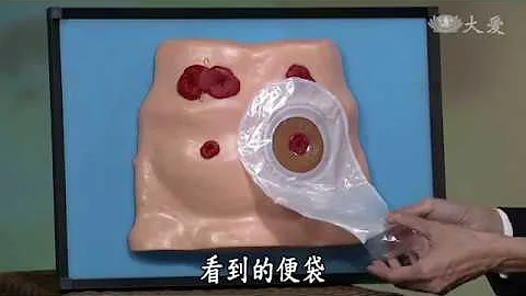 【志为人医守护爱】20171106 - 肠造口照护 - 肠肠久久 - 天天要闻