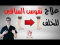 علاج رجوع الركبة للخلف تقوس الساقين للخلف Genu Recurvatum علاج رجوع الركبة للخلف تقوس الساقين للخلف Genu Recurvatum