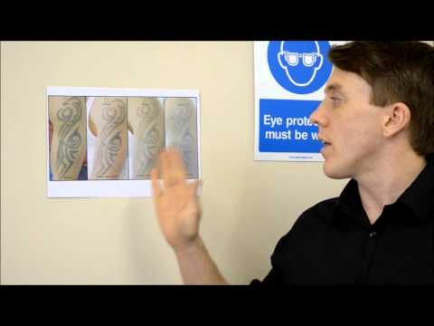 Laser Tattoo Removal in Chelmsford Essex at The Tattoo 