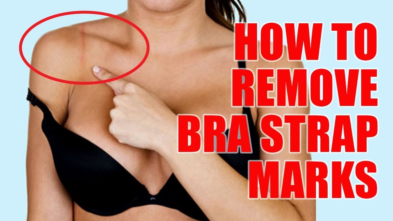 7 Natural Ways How to Remove Bra Strap Marks - StickeeBra 