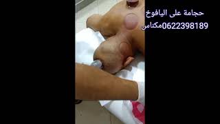 حجامة على اليافوخ اعلى الرأس#الحجامة_بمكناس_0622398189