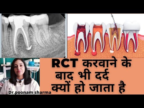 दांतों में रूट केनाल के बाद भी दर्द क्यों हो जाता है ||Pain after root canal treatment ||RCT Pain