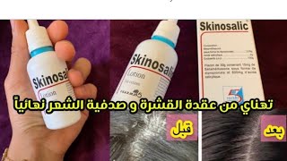 قهراتك القشرة وملقيتيش ليها الحل skinosalic هو لي غادي ينفعك ويهنيك من القشرة