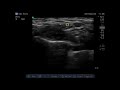 Ultrasound screening of suprascapular nerve by anterior approach