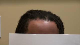 Specialized Hair Transplant Surgeon in African American Curly Hair by Dr. Diep