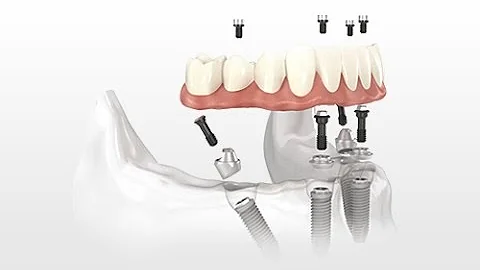 All-on-4 Dental Implants