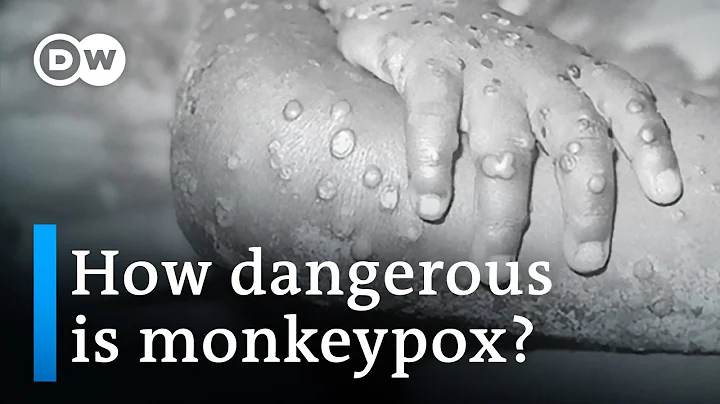 Concern grows as more countries detect monkeypox | DW News - DayDayNews