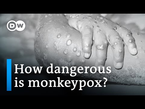 Video: Monkey pox. More countries confirm the detection of infections. So far, 80 cases have been confirmed in 14 countries