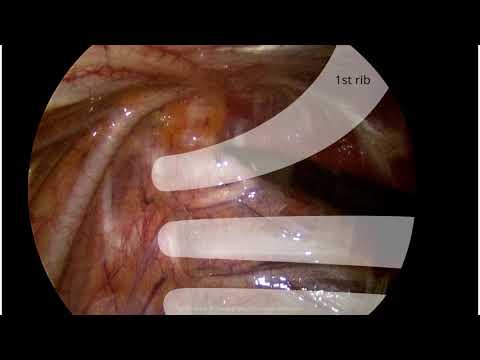 Sympathectomy for Hyperhidrosis