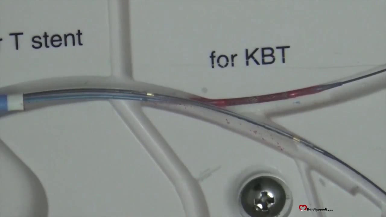 DK crush bifurcation stenting.