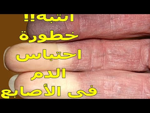 أسباب وعلاج احتباس الدم فى الأصبع معلومات هامه جدا