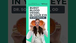 Is Your Eye Bloodshot What You Need To Know About Subconjunctival Hemorrhage Shared By Ct Eye Dr