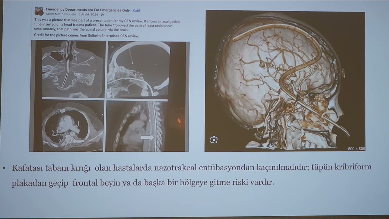 7.11.25 Travmatik Beyin Hasarı   Uzm. Dr. Nihal GÖKBULUT ÖZASLAN 