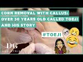 Corn removal with callus: over 30 years old called Toeji and his story
